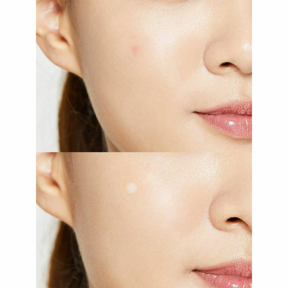 پچ ضد جوش کوزارکس Cosrx Acne Pimple Master Patch
